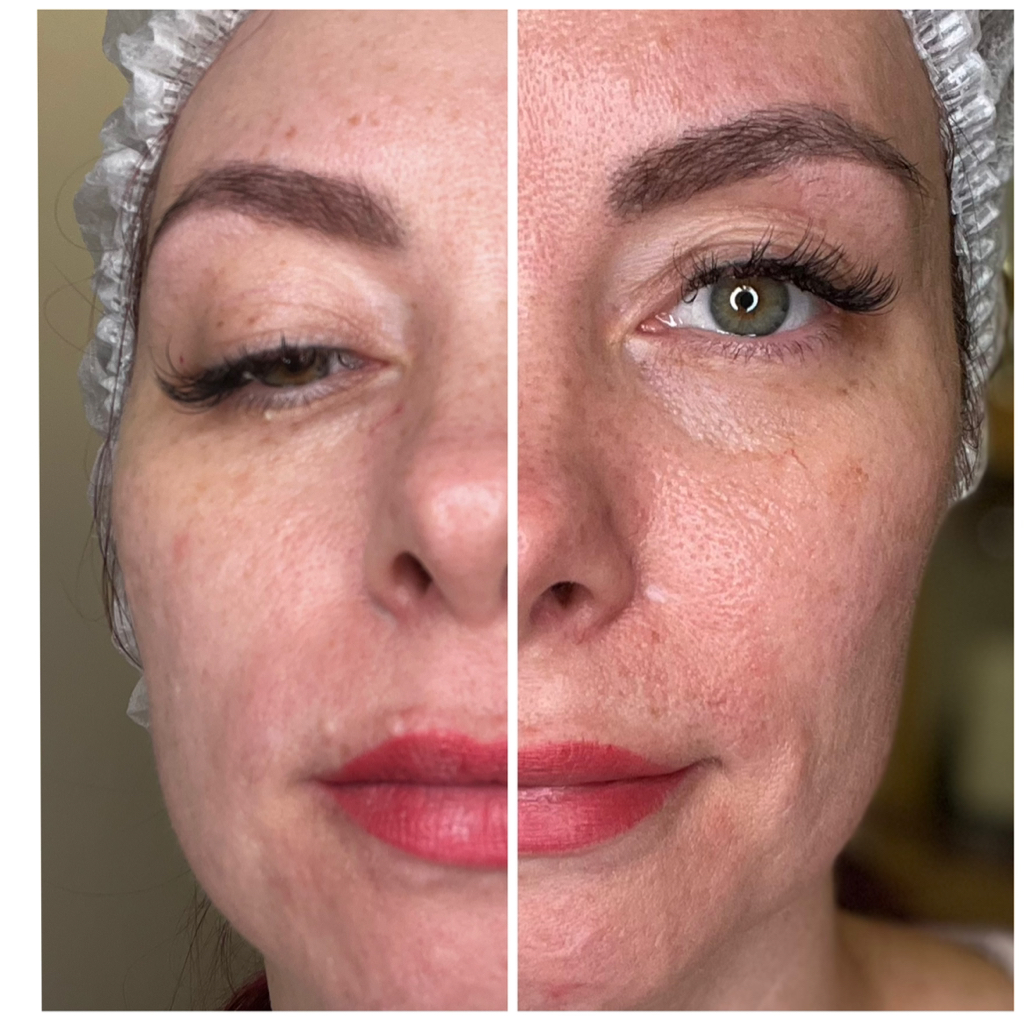 Rf-лифтинг лица шеи декольте 1,5 часа