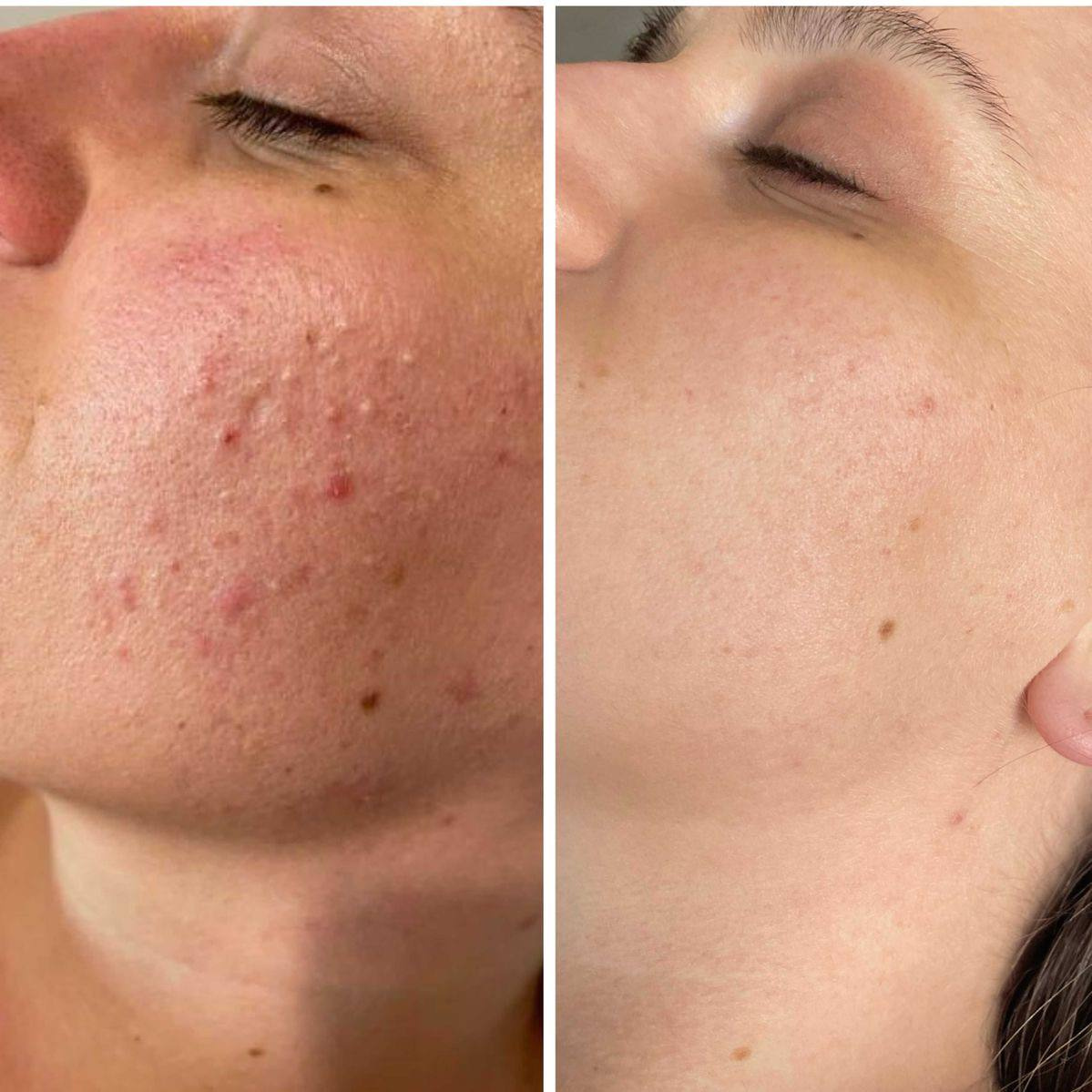 «СВЕЖЕСТЬ ДНЯ» процедура для жирной кожи