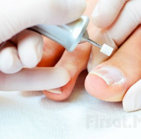 Снятие скобы , диагностика (Доп. к педикюру)