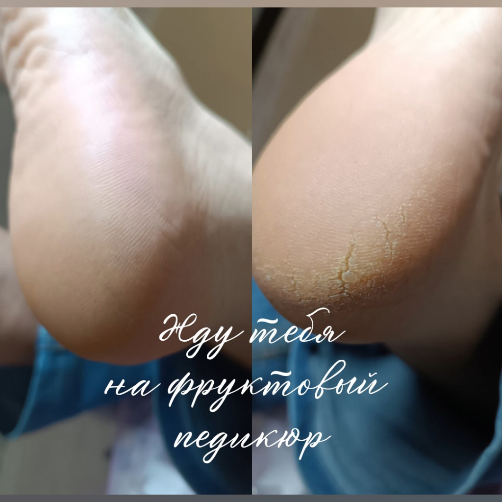 Фруктовый педикюр