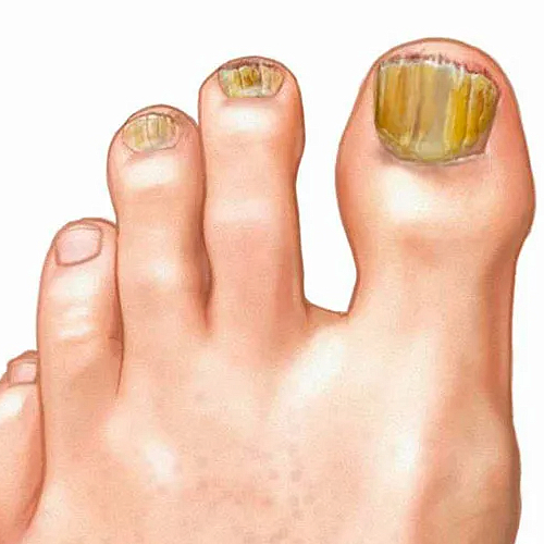 Микоз(грибок) (Доп. к педикюру )