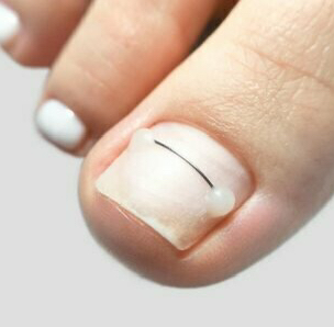 Коррекция вросшего ногтя   системой «Титановая нить» (II–V пальцы стоп)