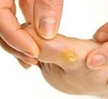 Стержневые мозоли / натоптыши (Доп. к педикюру)