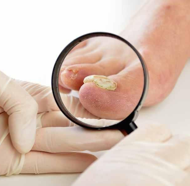 Скрученные ногти (Доп. к педикюру)