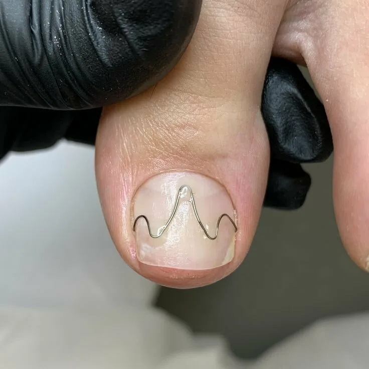 Коррекция вросшего ногтя скобой UNIBRACE