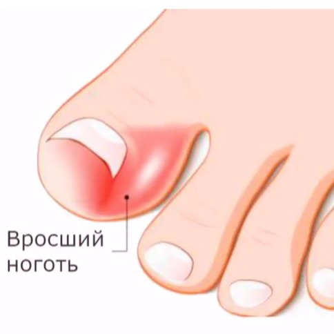 Эстетическая обработка вросших сегментов ногтя (II степень)