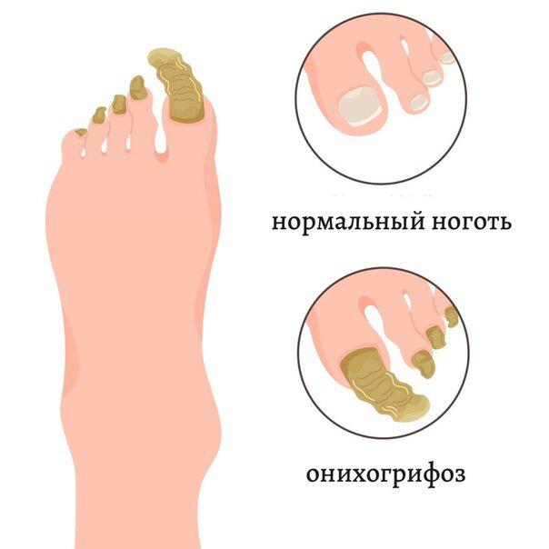 Грифозные ногти (Доп. к педикюру)