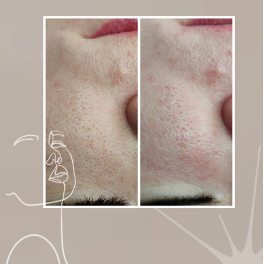 Комбинированная чистка лица + пилинг + нанесение маски