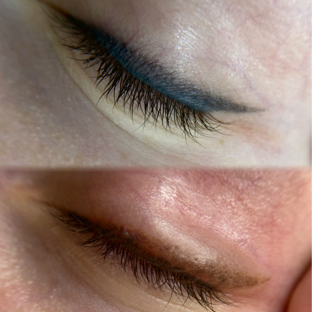 Осветление «веки»