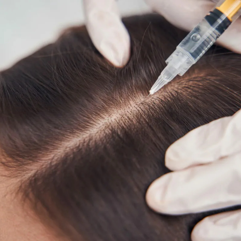 Мезотерапия ГОЛОВЫ