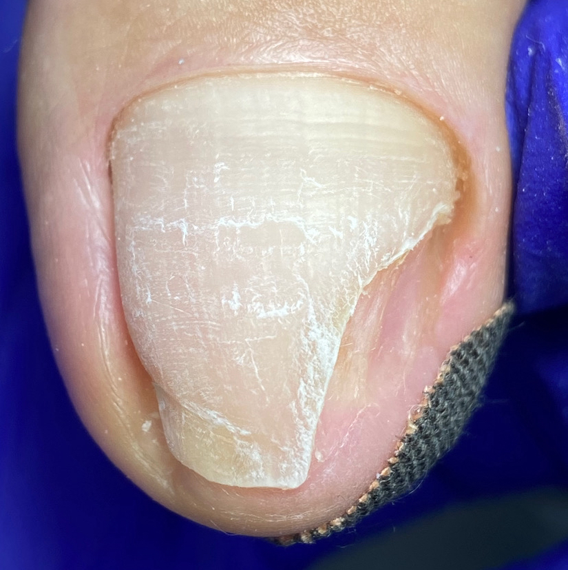 Зачистка онихолизиса