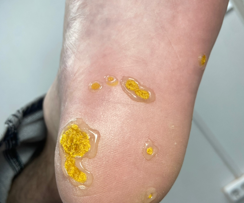 Повторный прием поверхностных омозолелости