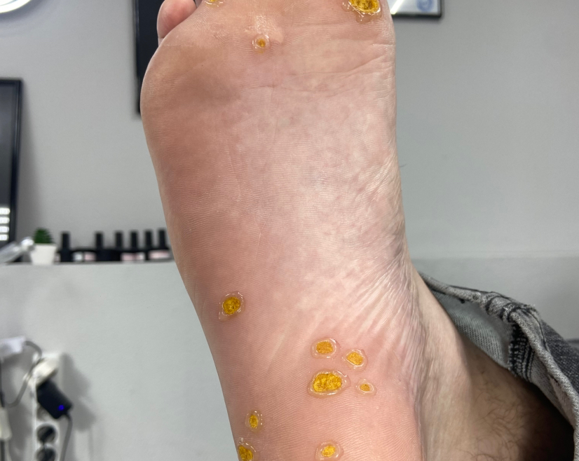 Первичный прием поверхностные омозолелости (1-10шт)