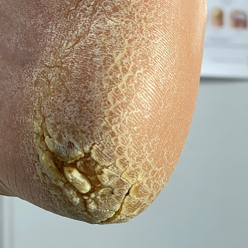 Комплексная обработка стоп и пальцев с обработкой омозолелостей