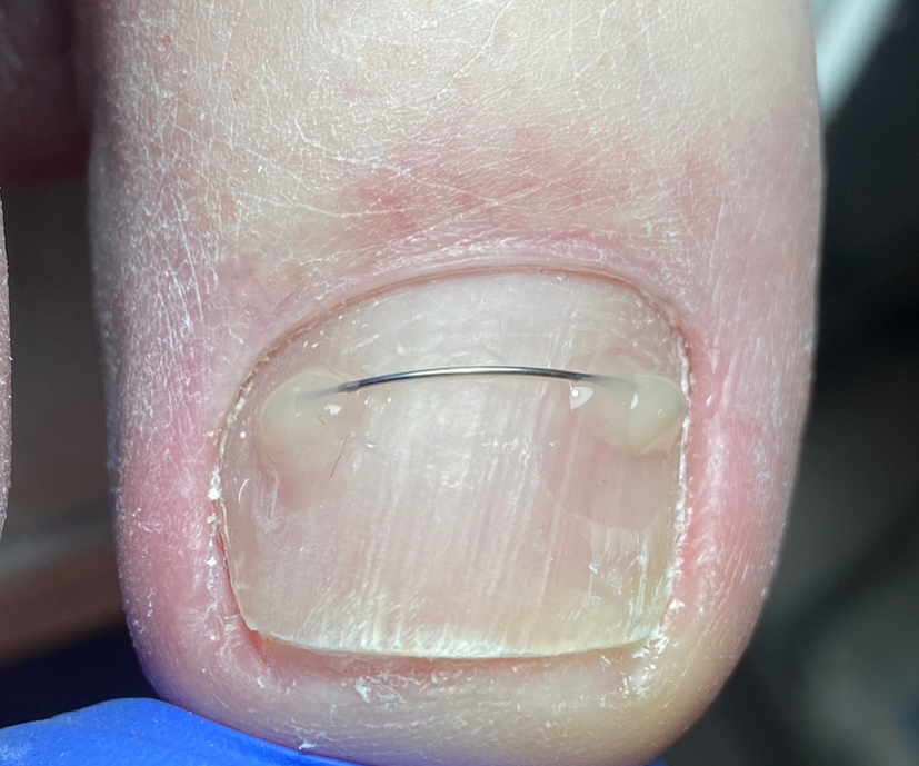 Установка коррекционной системы (титановая нить)