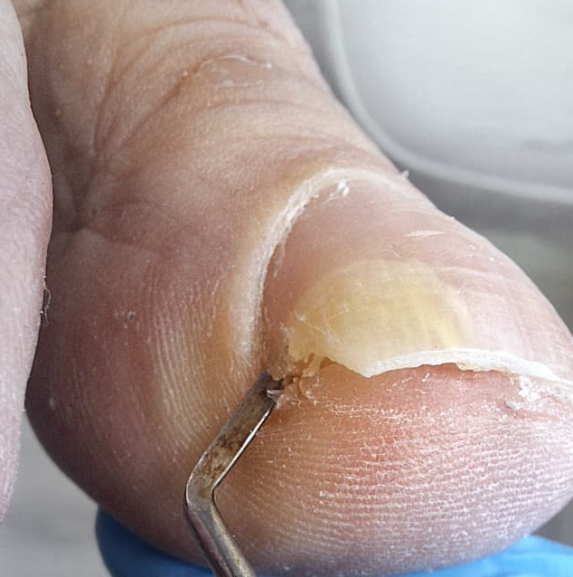 Вросший ноготь