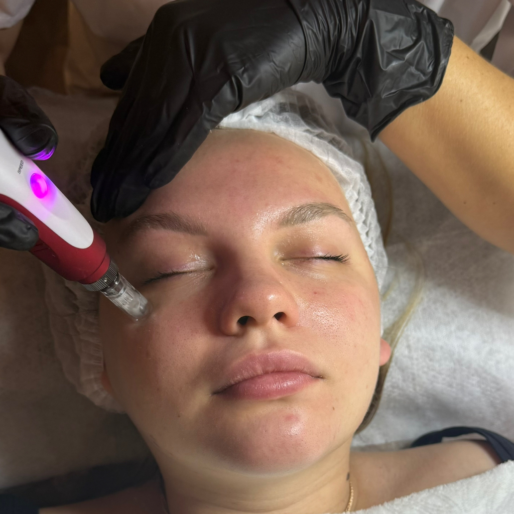 Микронидлинг (фракционная мезотерапия)