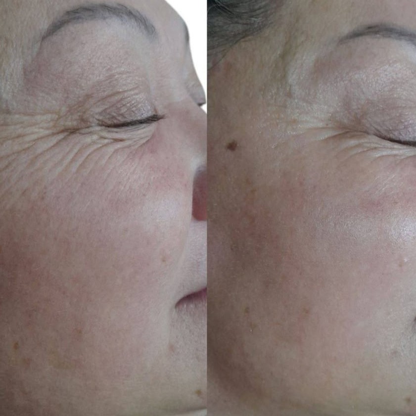 Омолаживающая процедура за лицом FlaxLift. 

Снижение тонуса и эластичности кожи;
Мелкие и глубокие морщины;
Пигментные пятна, темные круги под глазам