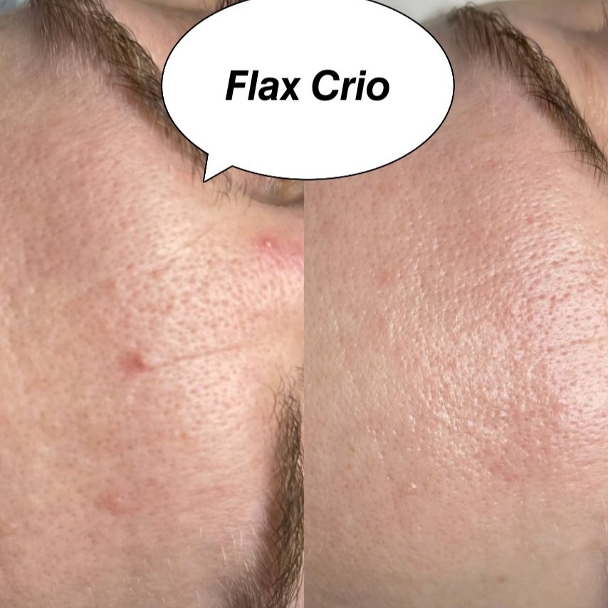 Омолаживающая процедура FlaxCrio. 

Процедура активизирует кровообращение и лимфоток, стимулирует обновление клеток, улучшает тонус и цвет лица, а так