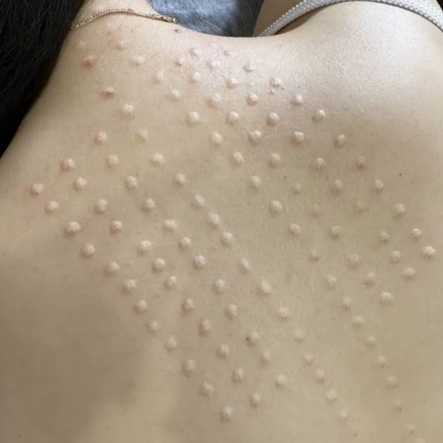 Сосудистый этап мезо