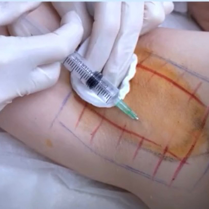 Лечение гипергидроза подмышки