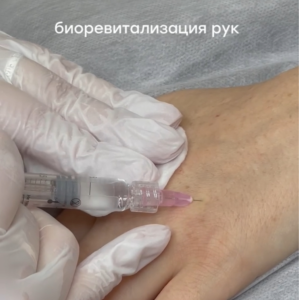 Биоревитализация рук