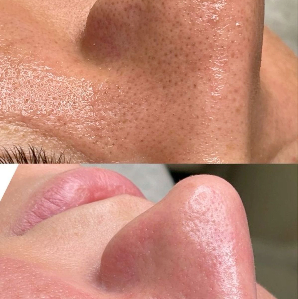 Чистка лица