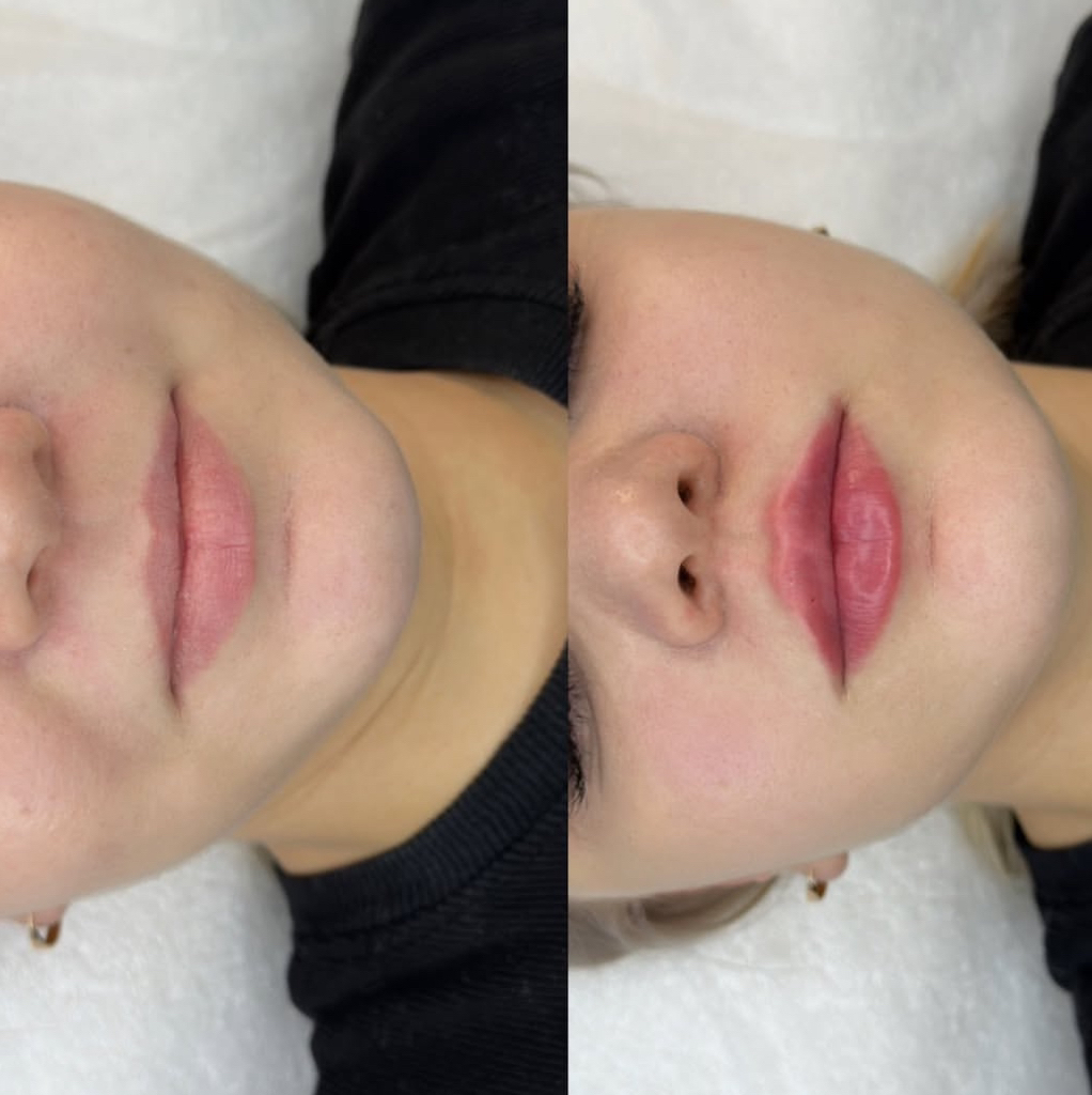 Контурная пластика губ