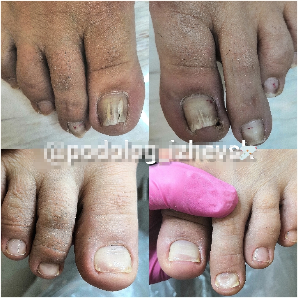 Переустановка  2х(двух) Скоб