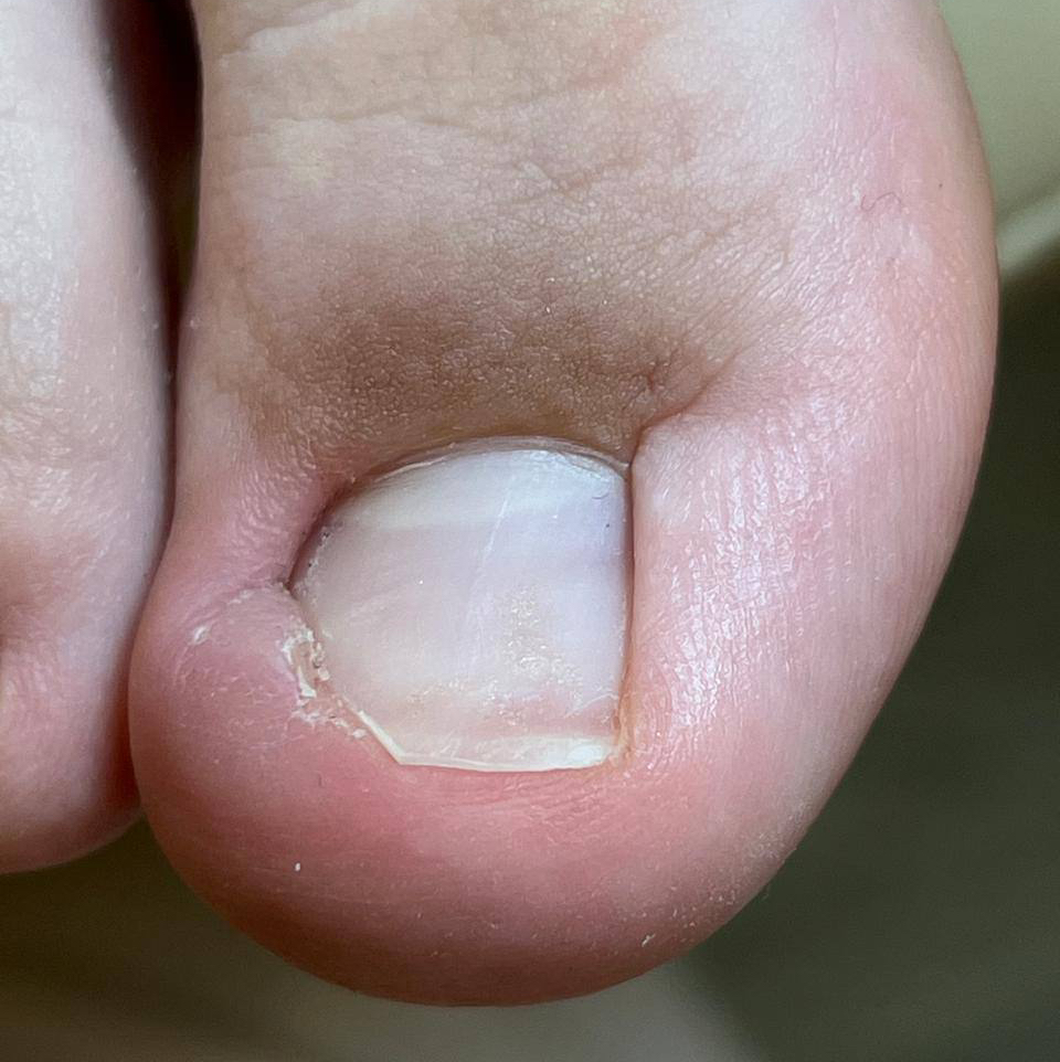 Вросший ноготь