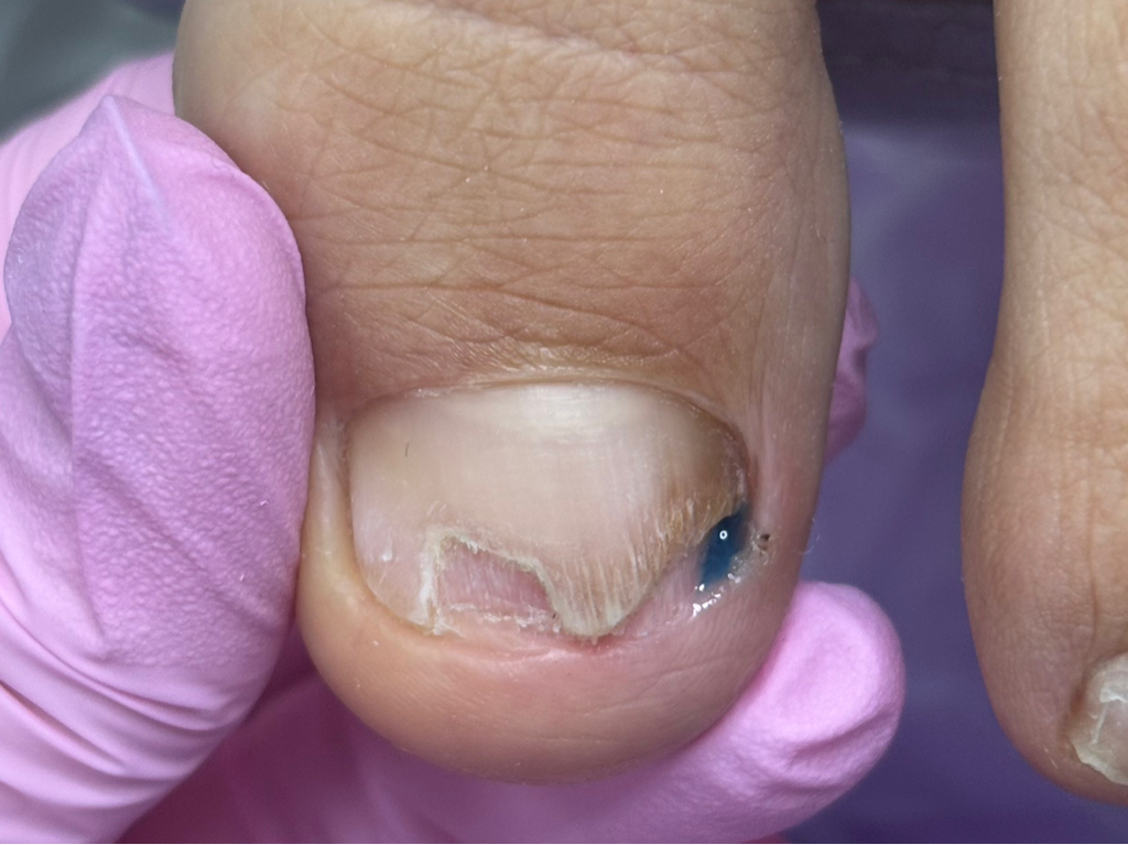 Зачистка 2/3 (большой палец)