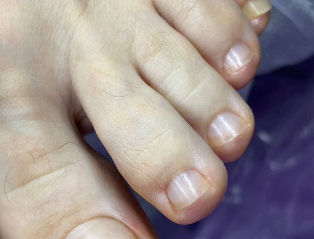 Подологическая обработка ногтей