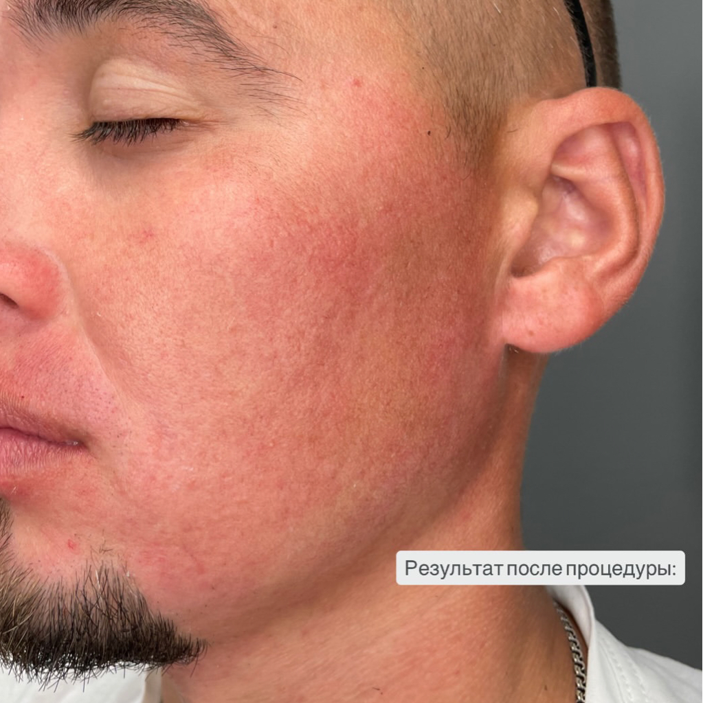 Депиляция лица