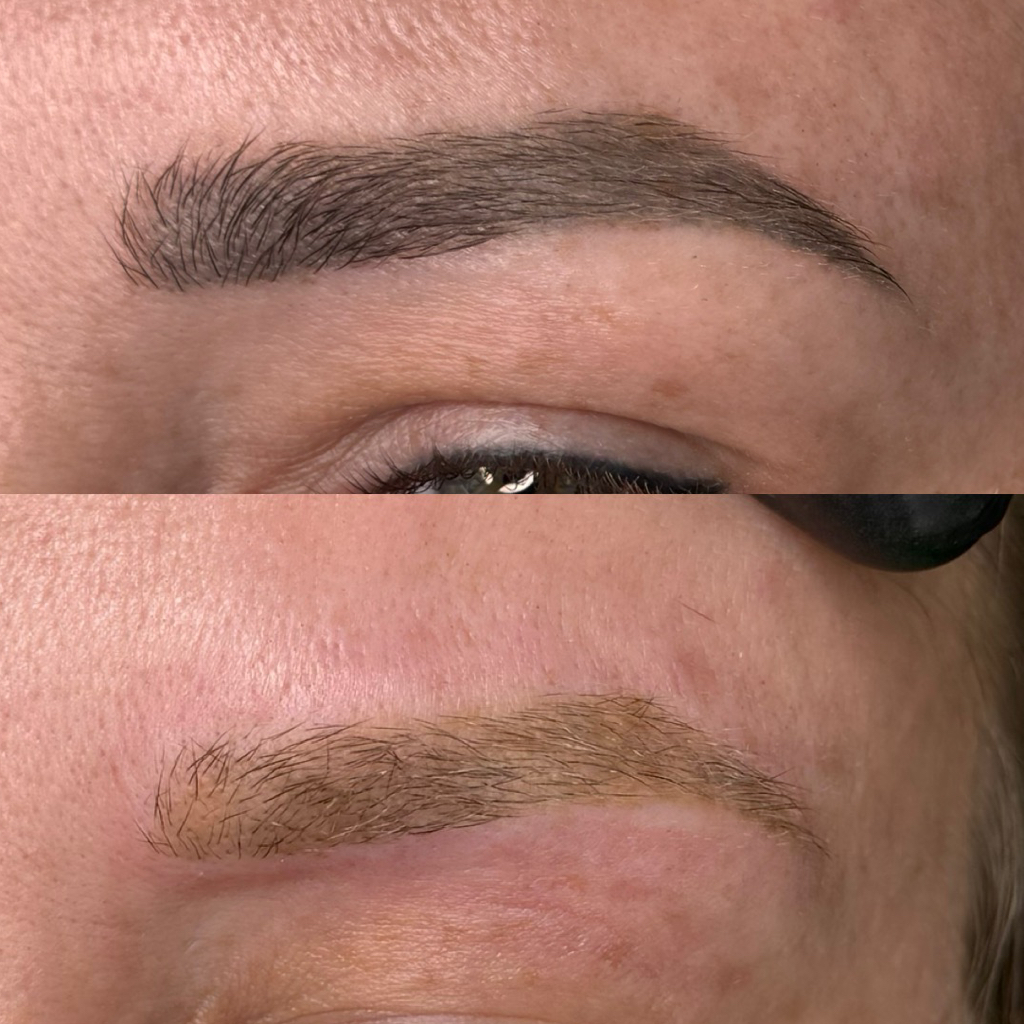 Осветление татуажа лазером (1 зона)