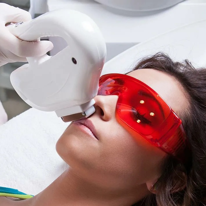 Эпиляция лица лазером