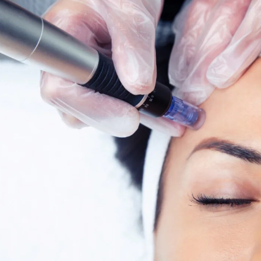 Микронидлинг (DermaPen)фракционная мезотерапия