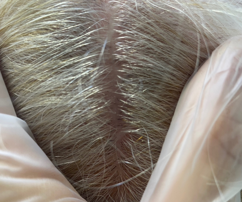 Мезотерапия Волос