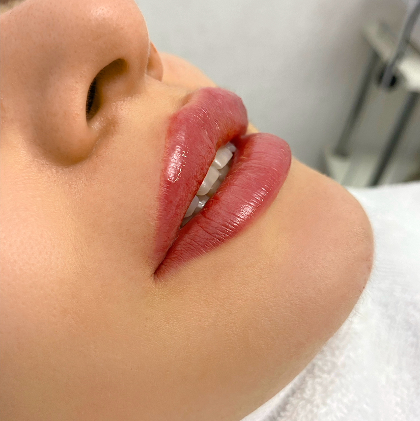 Увеличение губ