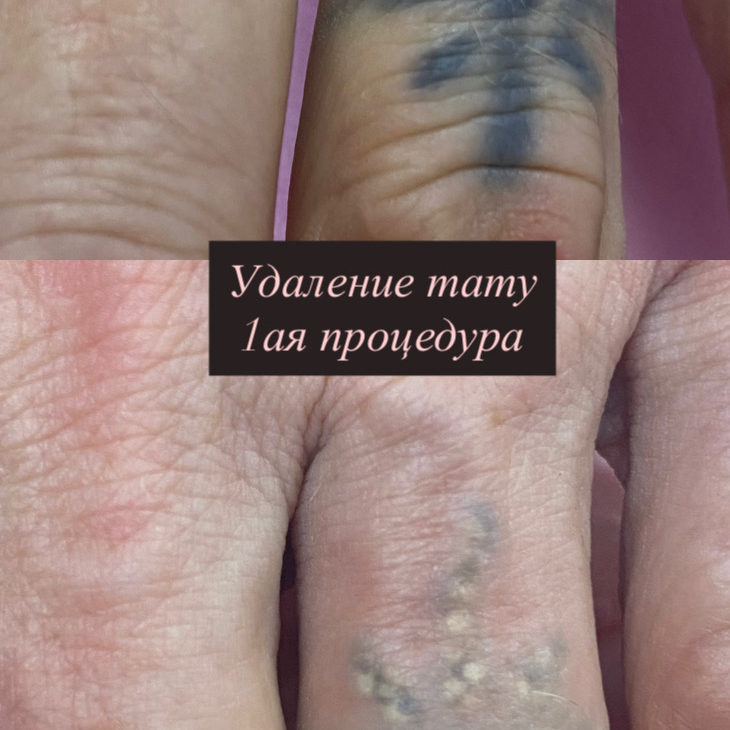 Удаление Тату
