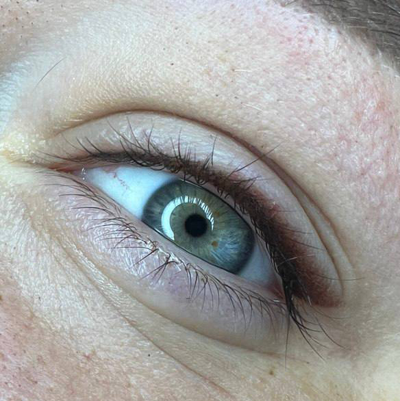 Межресничка теневая (первичная процедура)