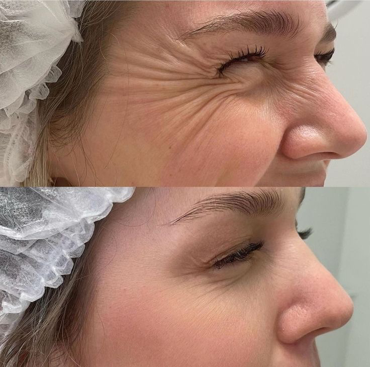 Ботокс углы глаз