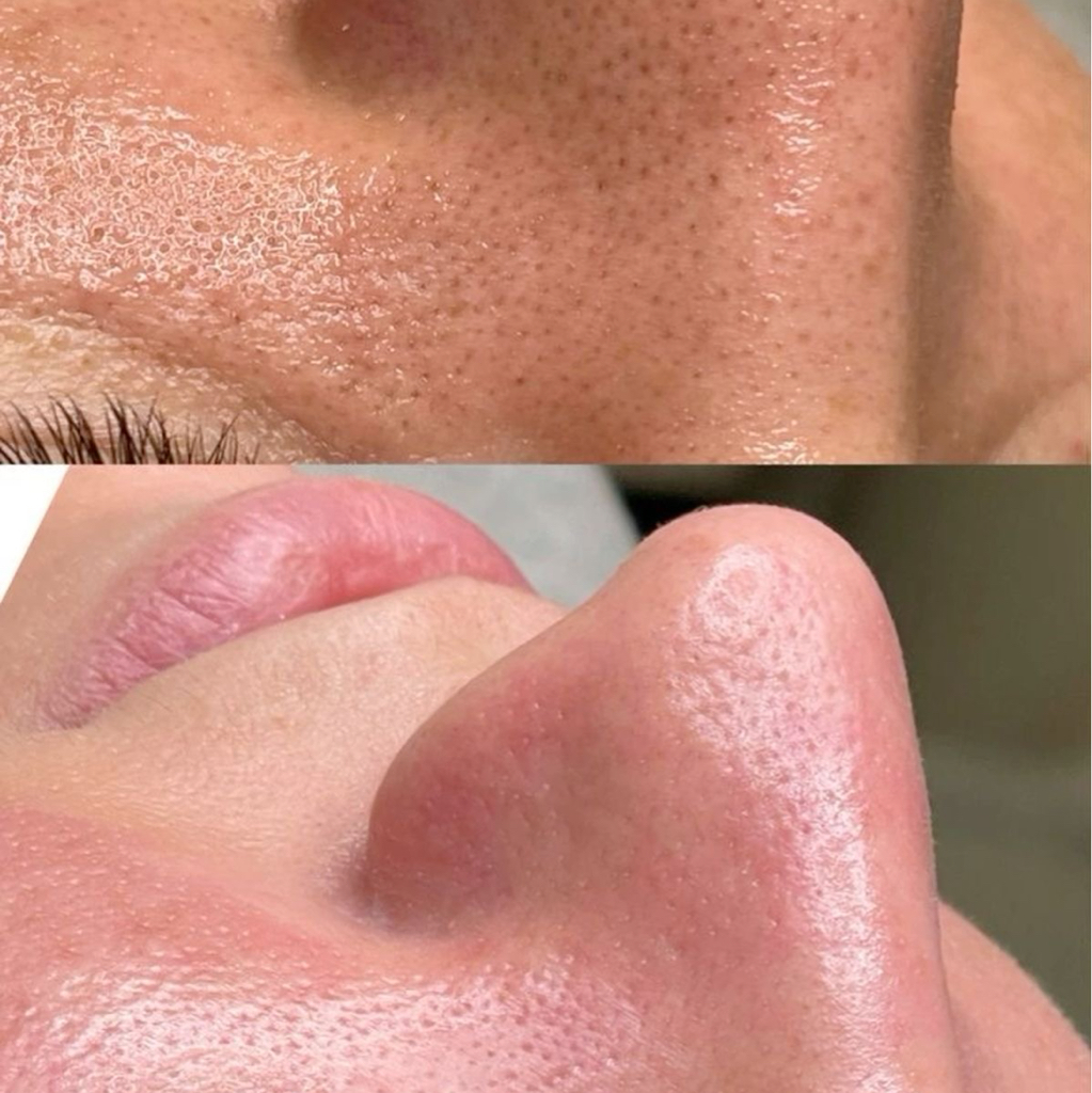 чистка «hydrafacial» полный комплекс + уход Yon-ka