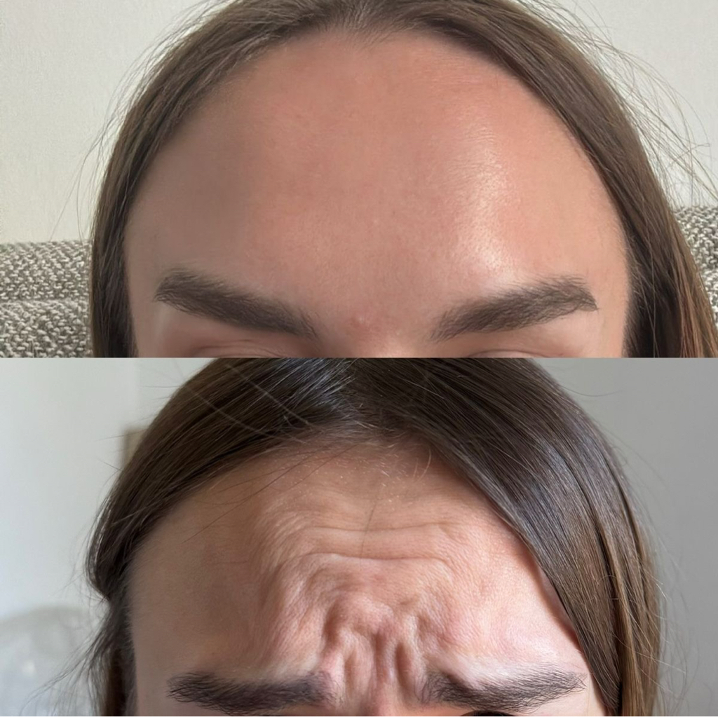 Ботокс лоб,межбровье