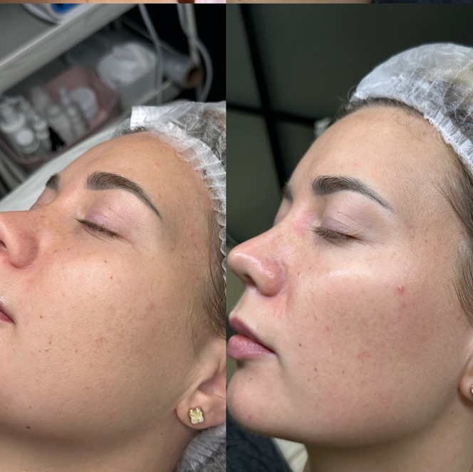 Пилинг + карбокситерапия