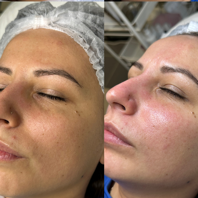 Комби чистка + пилинг