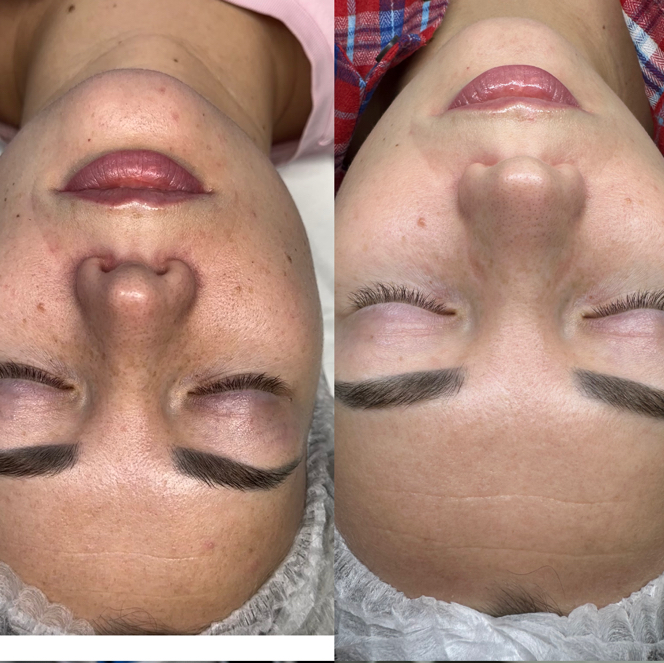 Пилинг лечебный