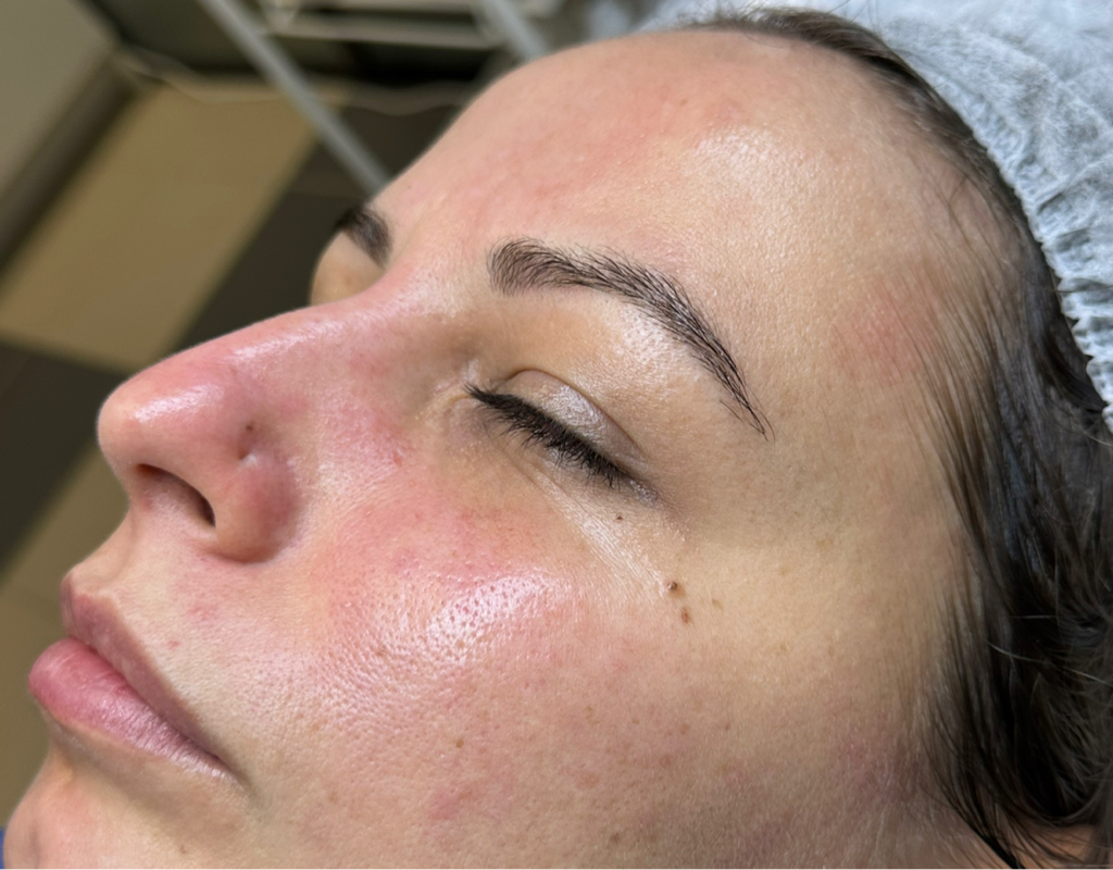 Чистка лица комбинированная