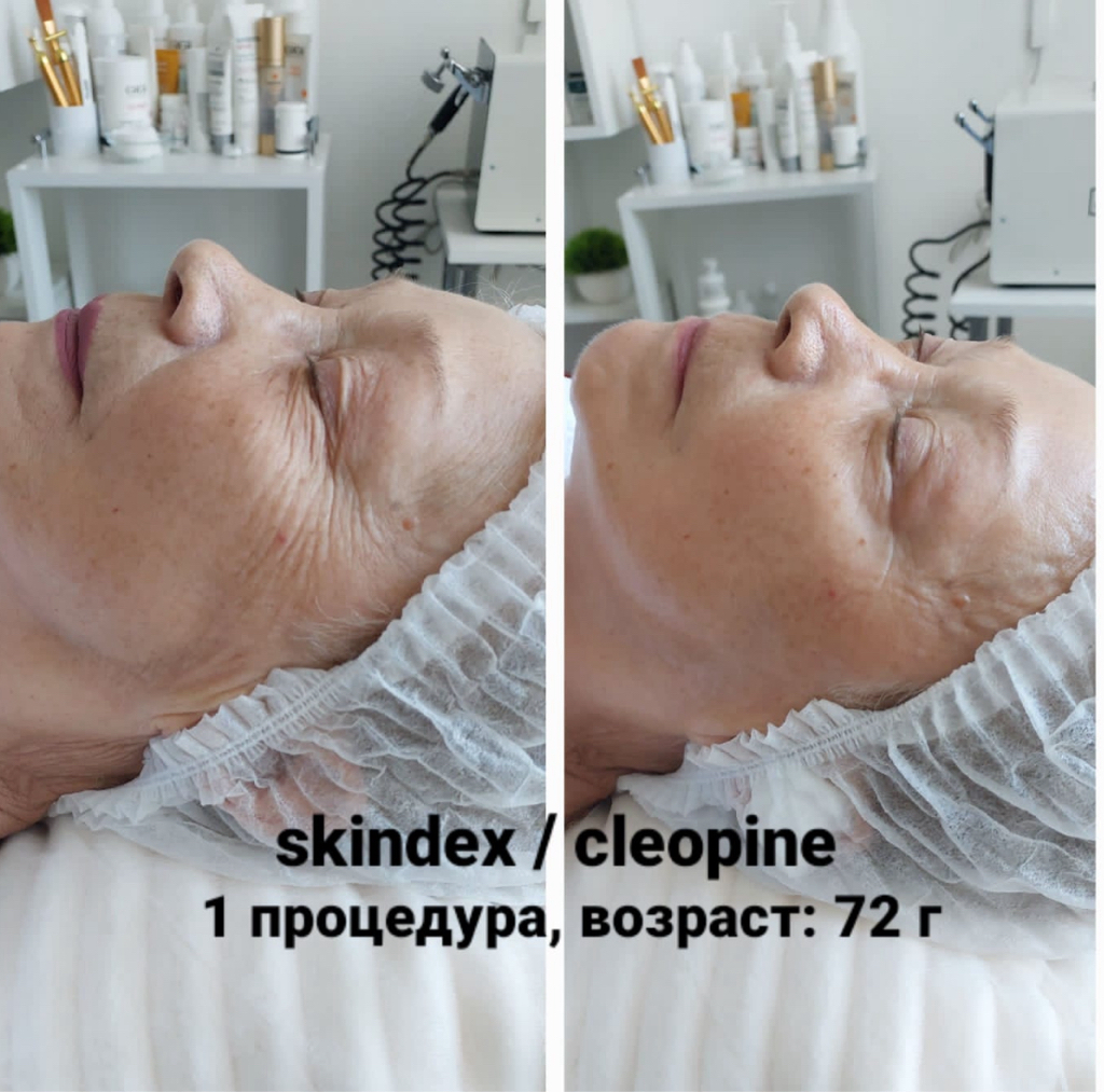 Безинъекционное омоложение «SKINDEX”