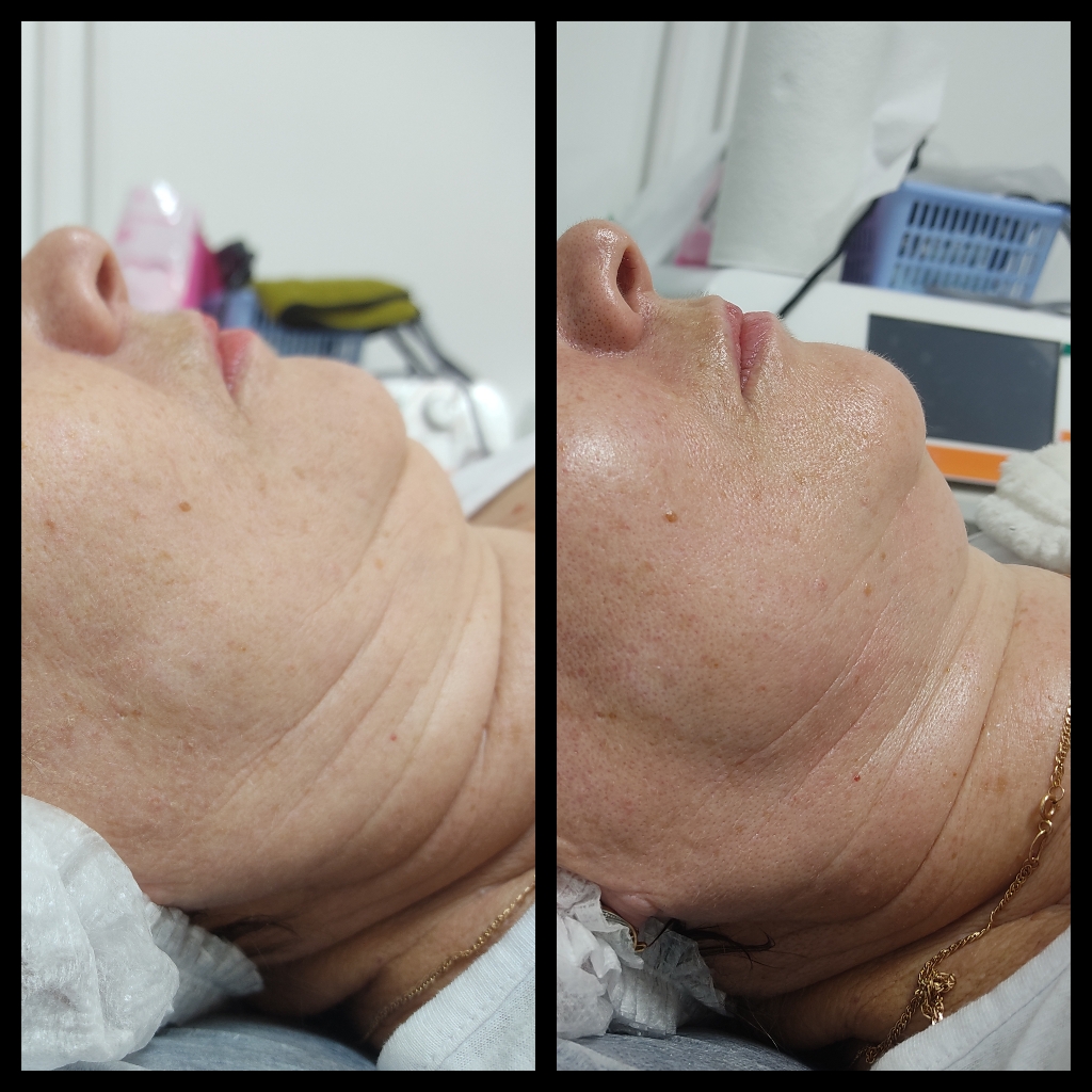 Ойлисомальное оможение