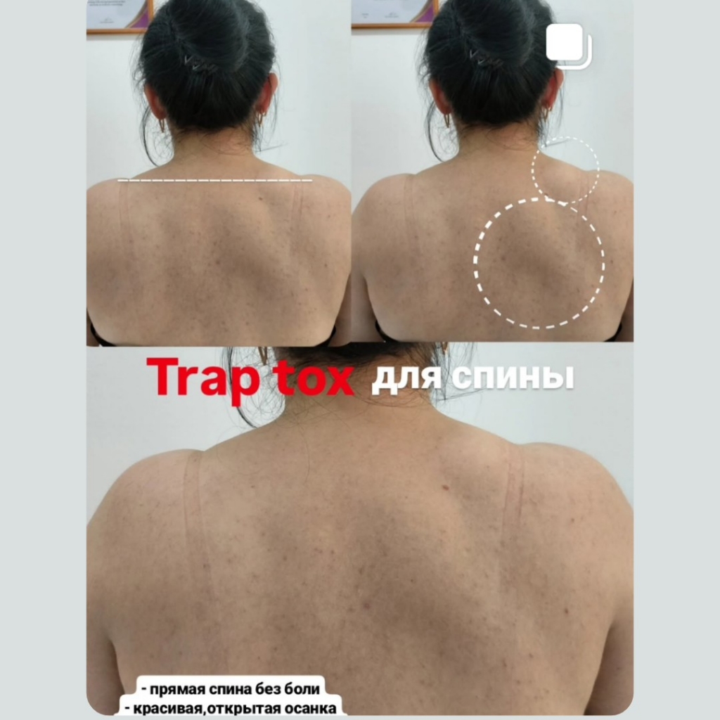 Trap Tox спины